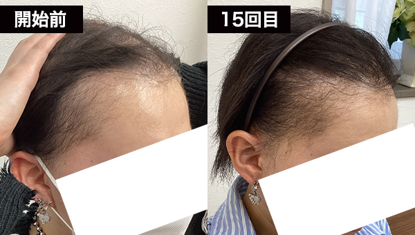 Hさん BeforeAfter